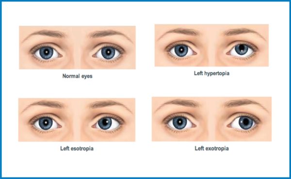 Best Squint Surgery Hospital In Indore Rajas Eye Hospital Expert Squint Correction Services 